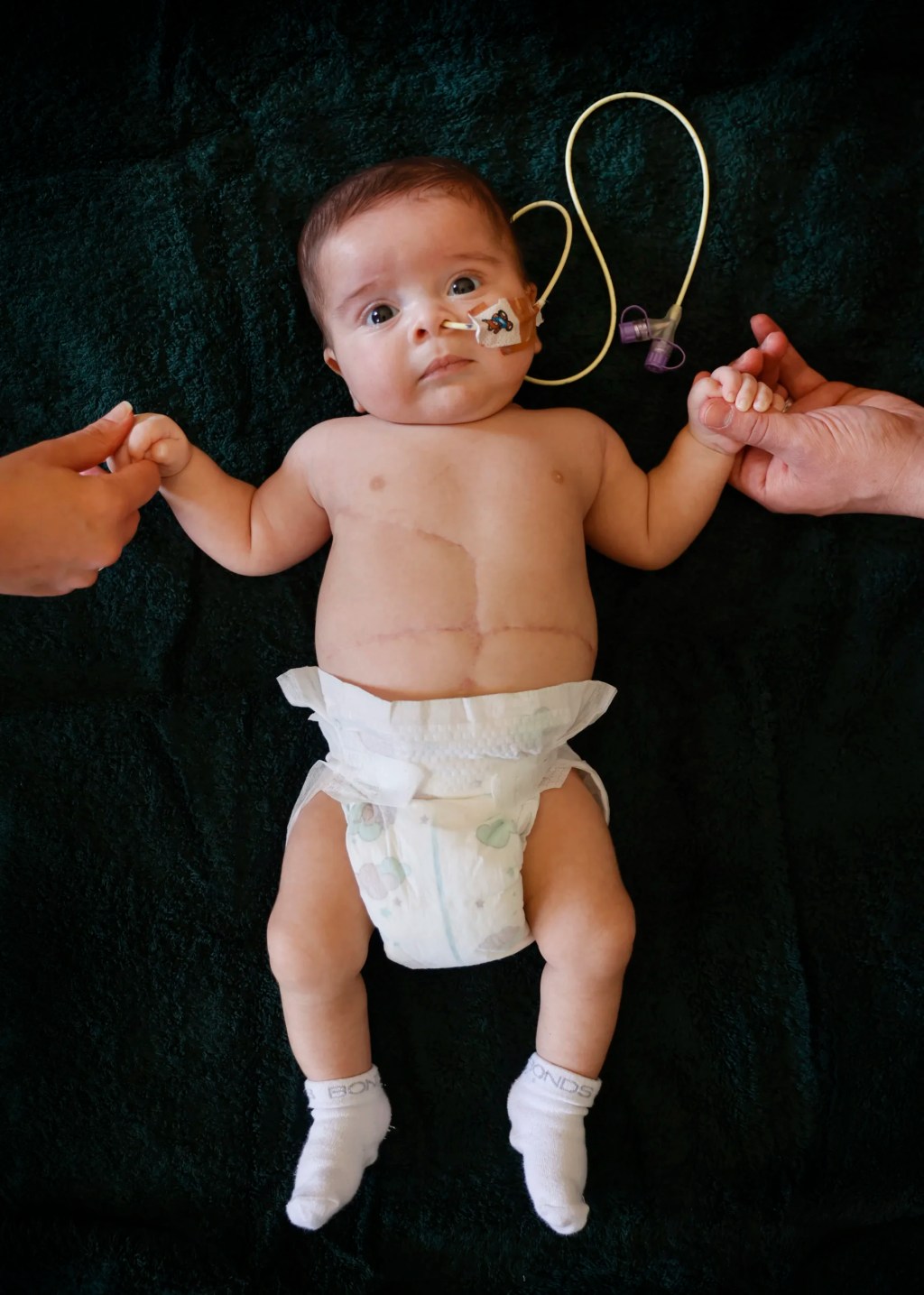 Baby tumour patient with hands held